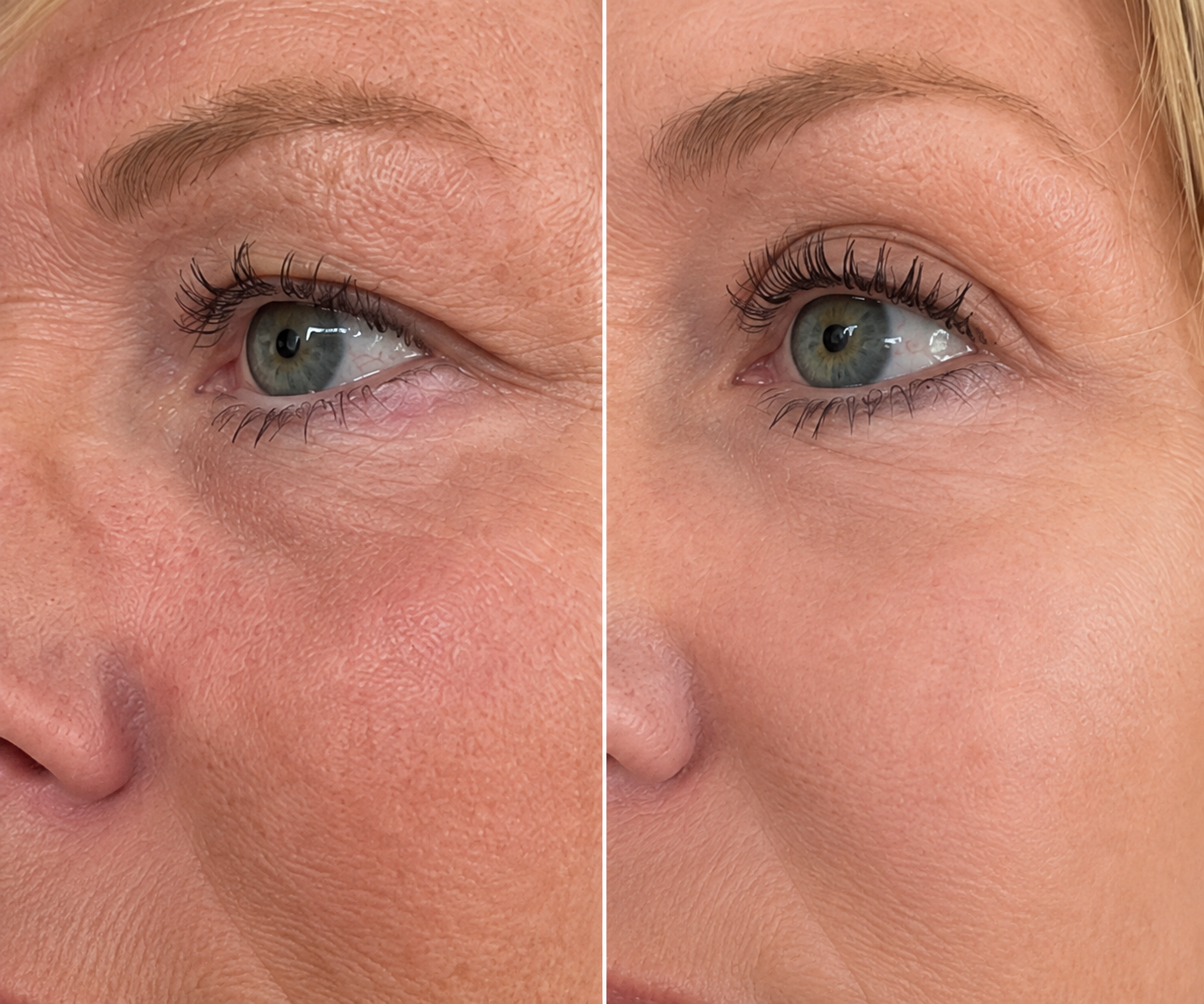 Before and after — Beverly M.